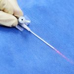 Sposoby usuwania żylaków