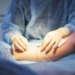 Skleroterapia – czym jest i kiedy najlepiej poddać się zabiegowi?