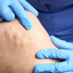 Laserowe usuwanie żylaków